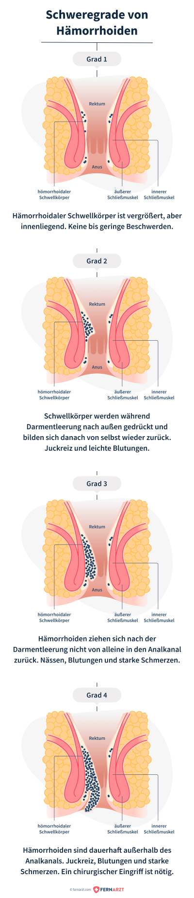 Vier Schweregrade von Hämorrhoiden anhand einer Grafik dargestellt