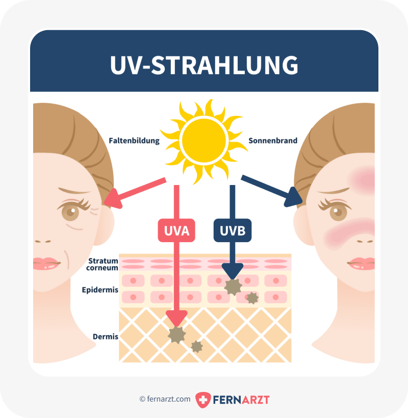 Sonnenlicht enthält UV-A- und UV-B-Strahlen. Sonnenbrand wird hauptsächlich durch UV-B-Strahlen verursacht.