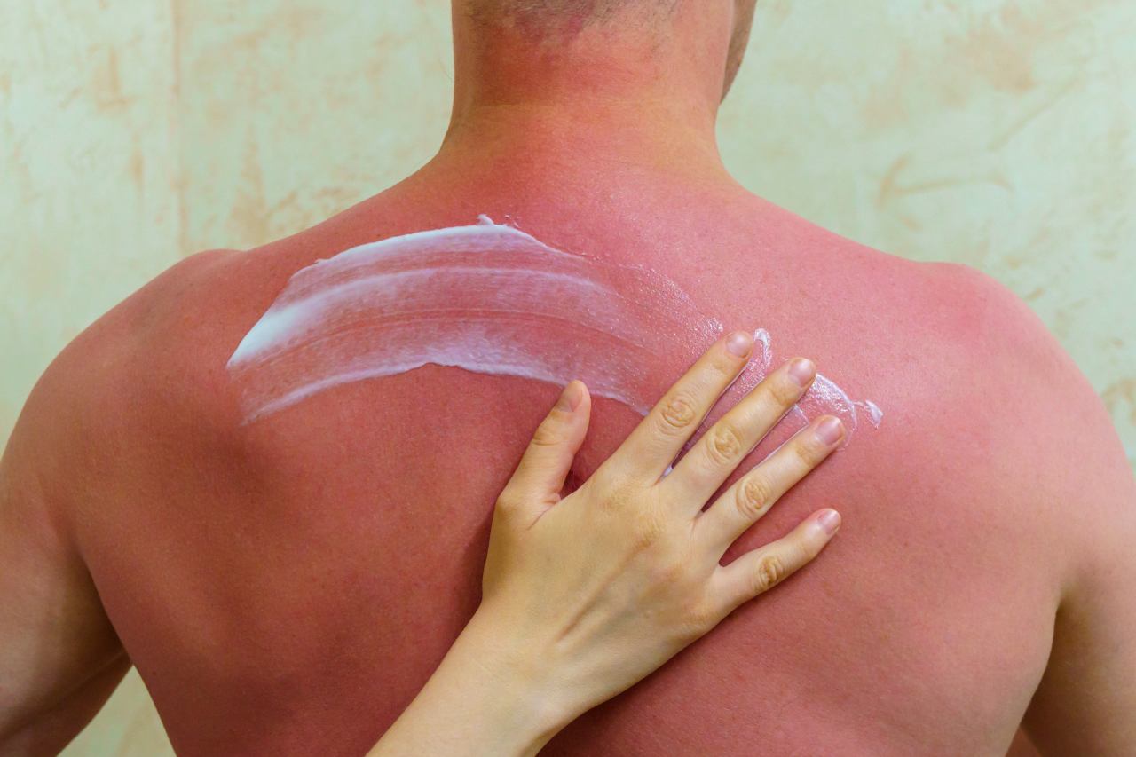 Sonnenbrand am Rücken wird eingecremt.