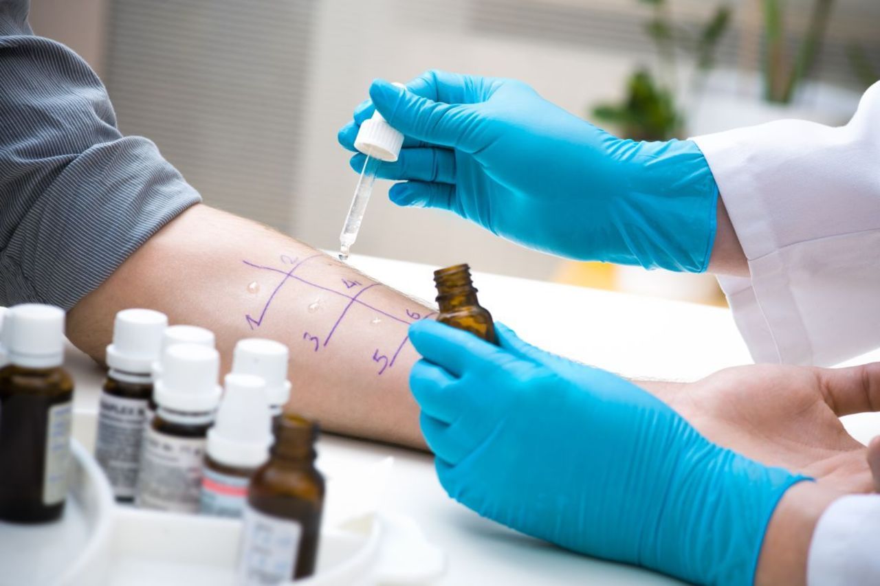 Dermatologe führt Allergie Pricktest am Unterarm durch