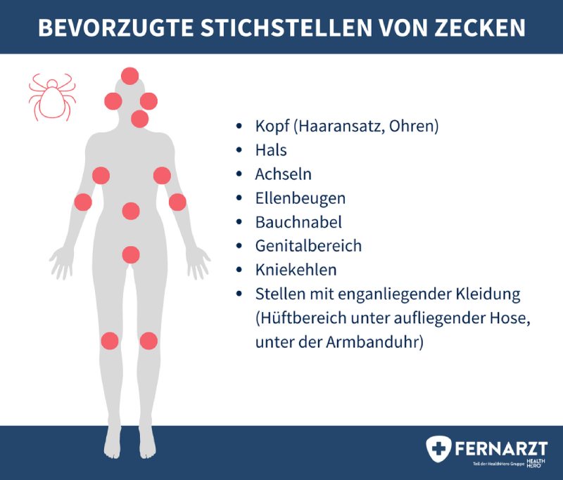 Darstellung der Körperstellen, an denen am häufigsten Zeckenstiche zu finden sind.