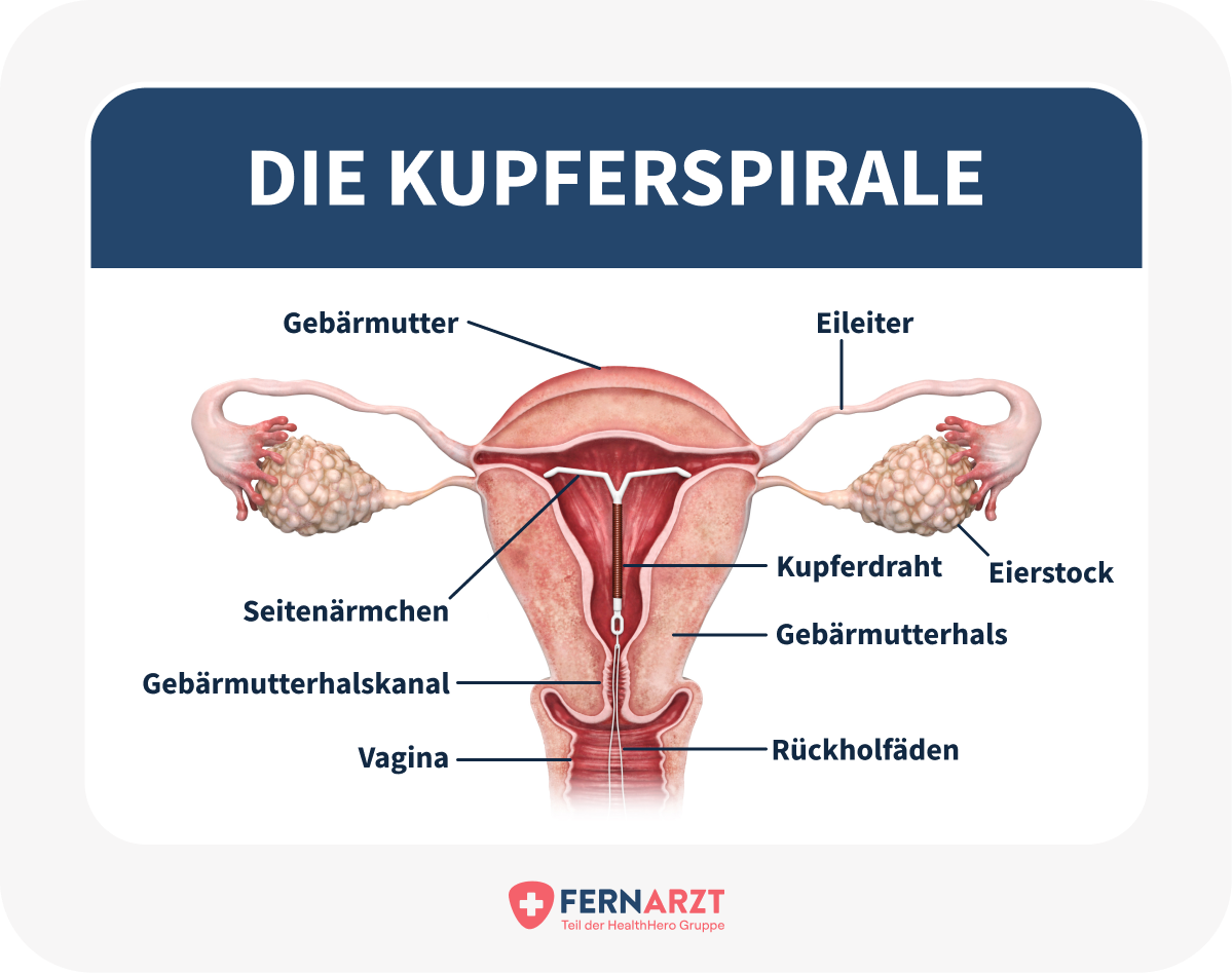 Darstellung der Kupferspirale innerhalb einer Gebärmutter.