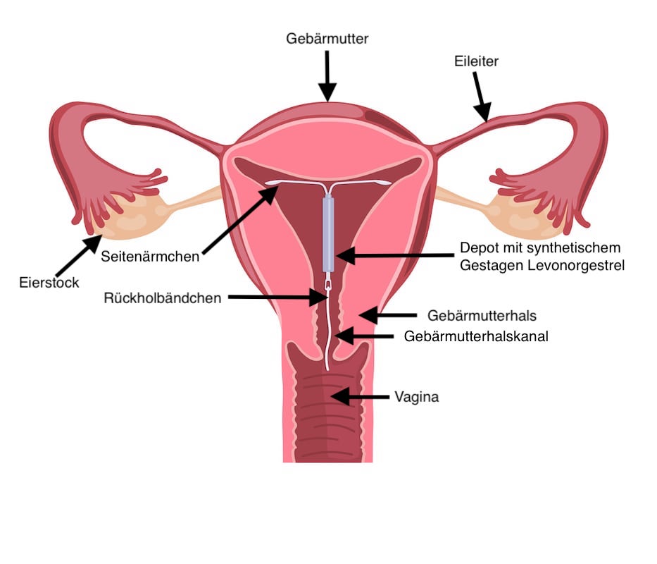 Hormonspirale 