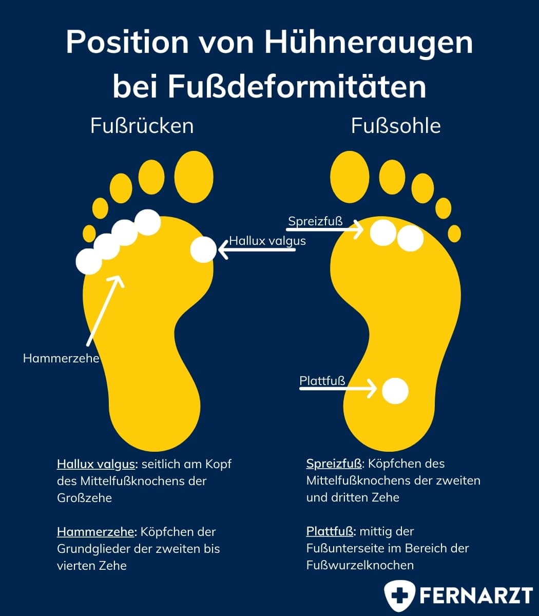 Position von Hühneraugen bei Fußdeformitäten.
