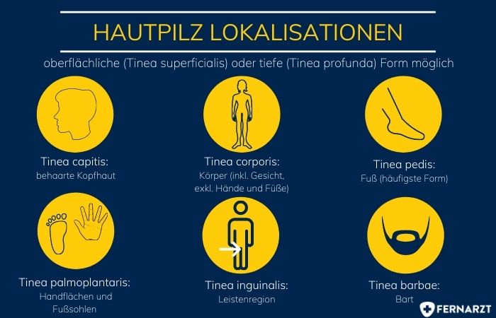 Grafische Darstellung der verschiedenen Lokalisationen von Hautpilz.