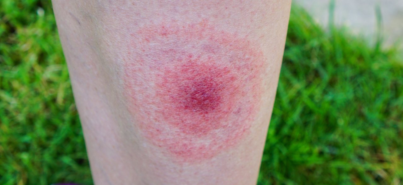 Die Wanderröte ist ein auffälliges Symptom bei Borreliose. Sie tritt etwa bei der Hälfte der Betroffenen auf.