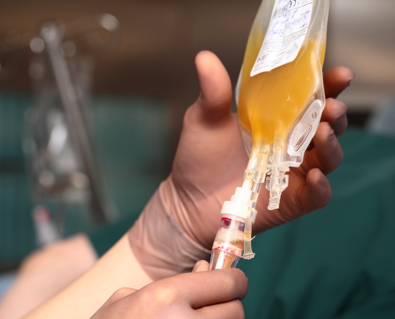 Blutspende: Blutplasma in einem Beutel für Transplantation.