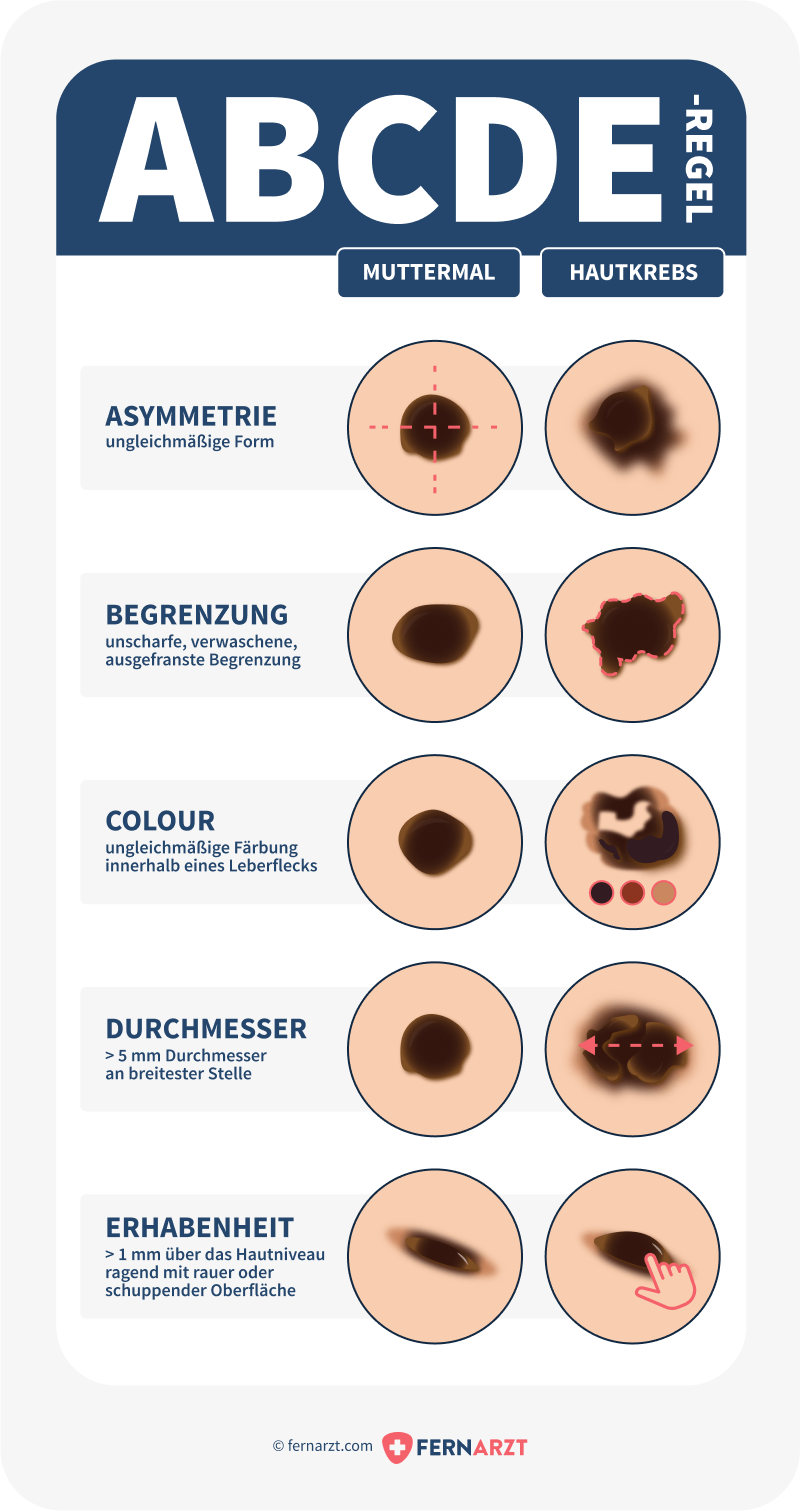 Übersicht über Merkmale für Hautkrebs 