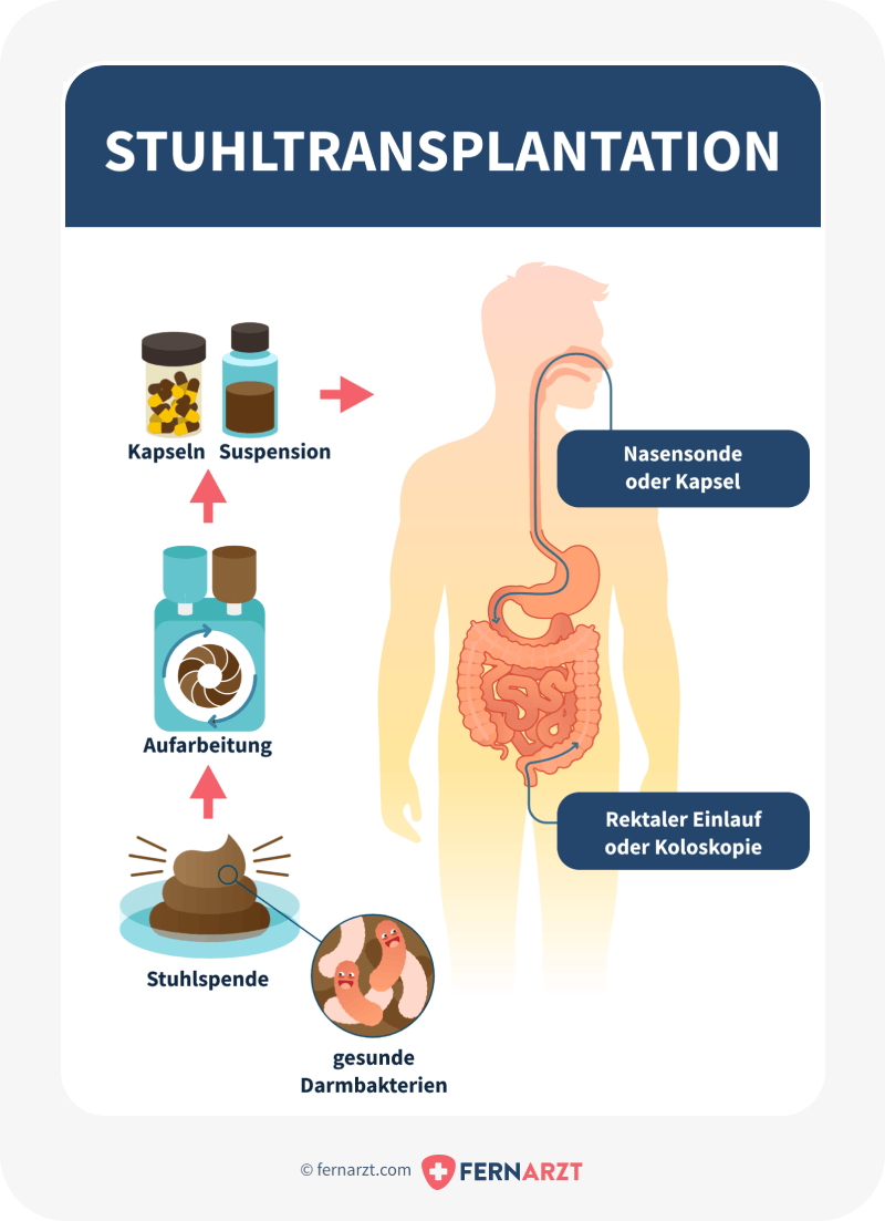 Der Ablauf einer Stuhltransplantation: Stuhlspende mit gesunden Darmbakterien wird in einem Labor aufbereitet. Die Darmbakterien können als Kapseln eingenommen werden oder als Suspension über eine Nasensonde oder einen rektalen Einlauf verabreicht werden.