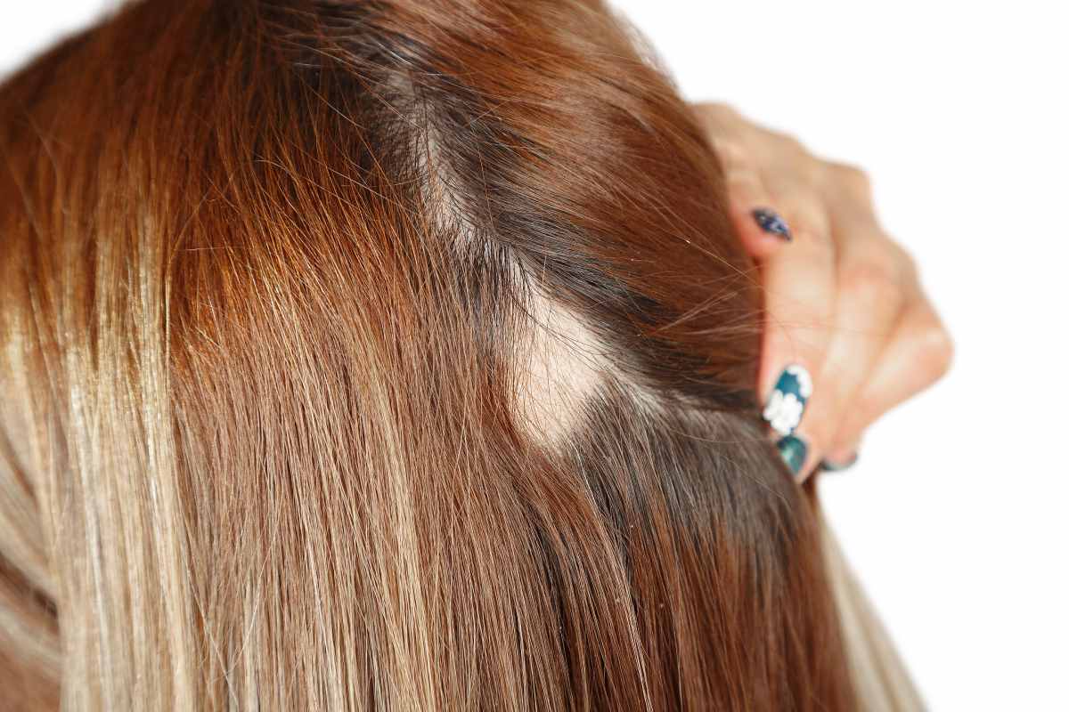 Kreisrunder Haarausfall oder Alopezie bei Frau mit langen Haaren.