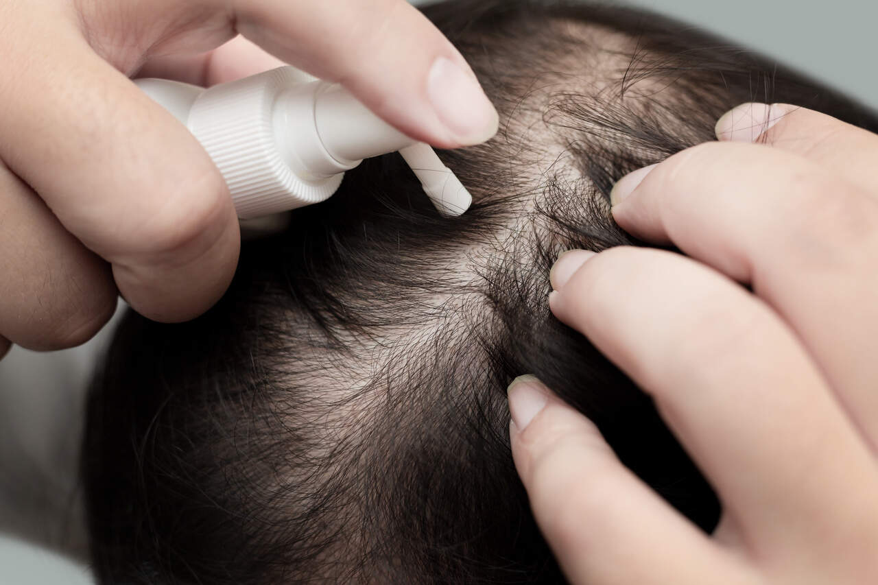 Was hilft gegen Haarausfall? Medikamente und Therapien | Fernarzt
