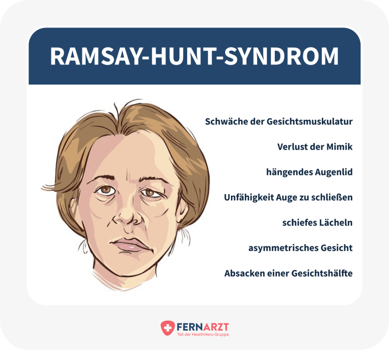 Ein Ramsay-Hunt-Syndrom besteht aus Gürtelrose am Ohr (Zoster oticus) und einer gleichseitigen peripheren Fazialisparese.