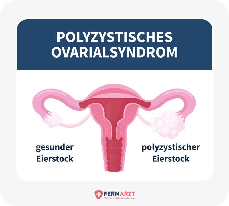 Das Polyzystische Ovarialsyndrom (PCOS). Vergleich eines gesunden Eierstocks mit einem polyzystischen Eierstock.