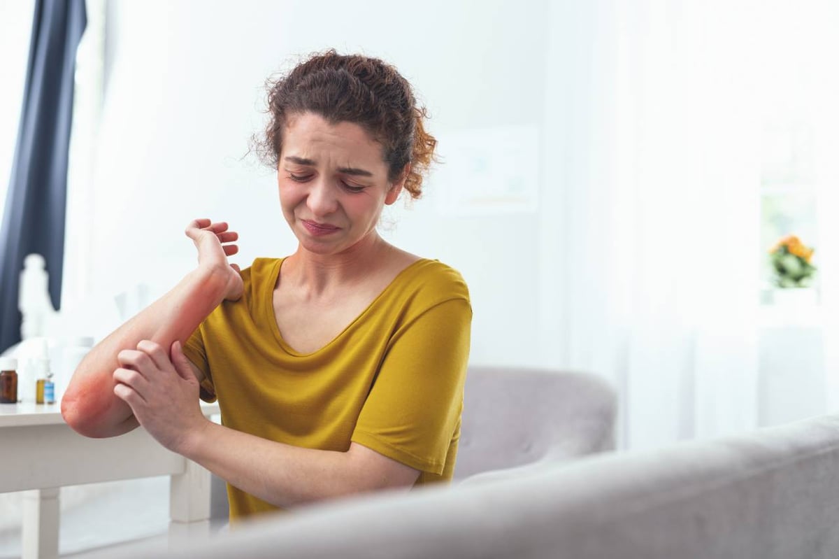 Histaminintoleranz: Junge Frau kratzt sich am Arm, der Arm ist schon rot vom vielen Kratzen.