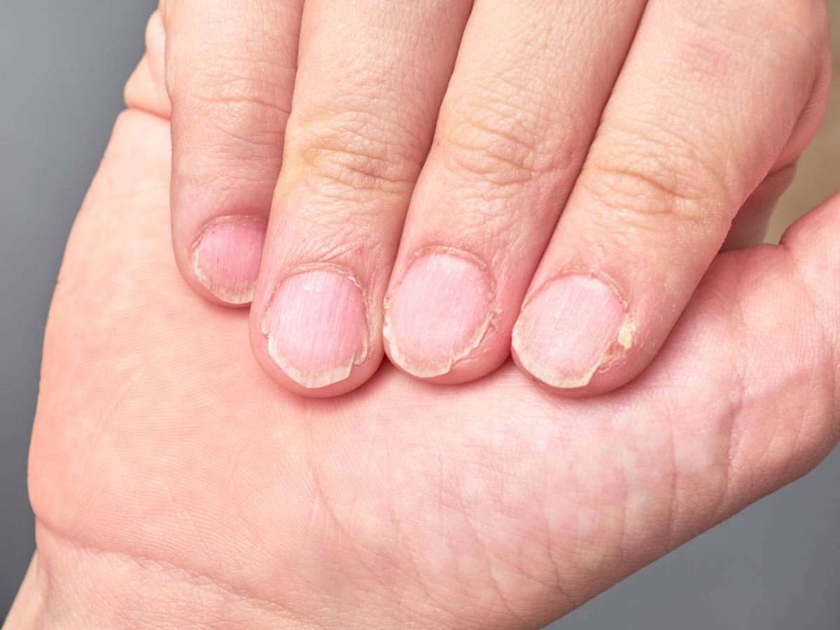 Hand mit brüchigen Fingernägeln.