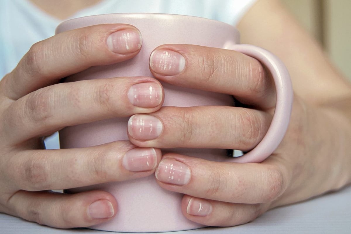 Hände mit weißen Flecken auf den Fingernägeln halten eine Tasse.