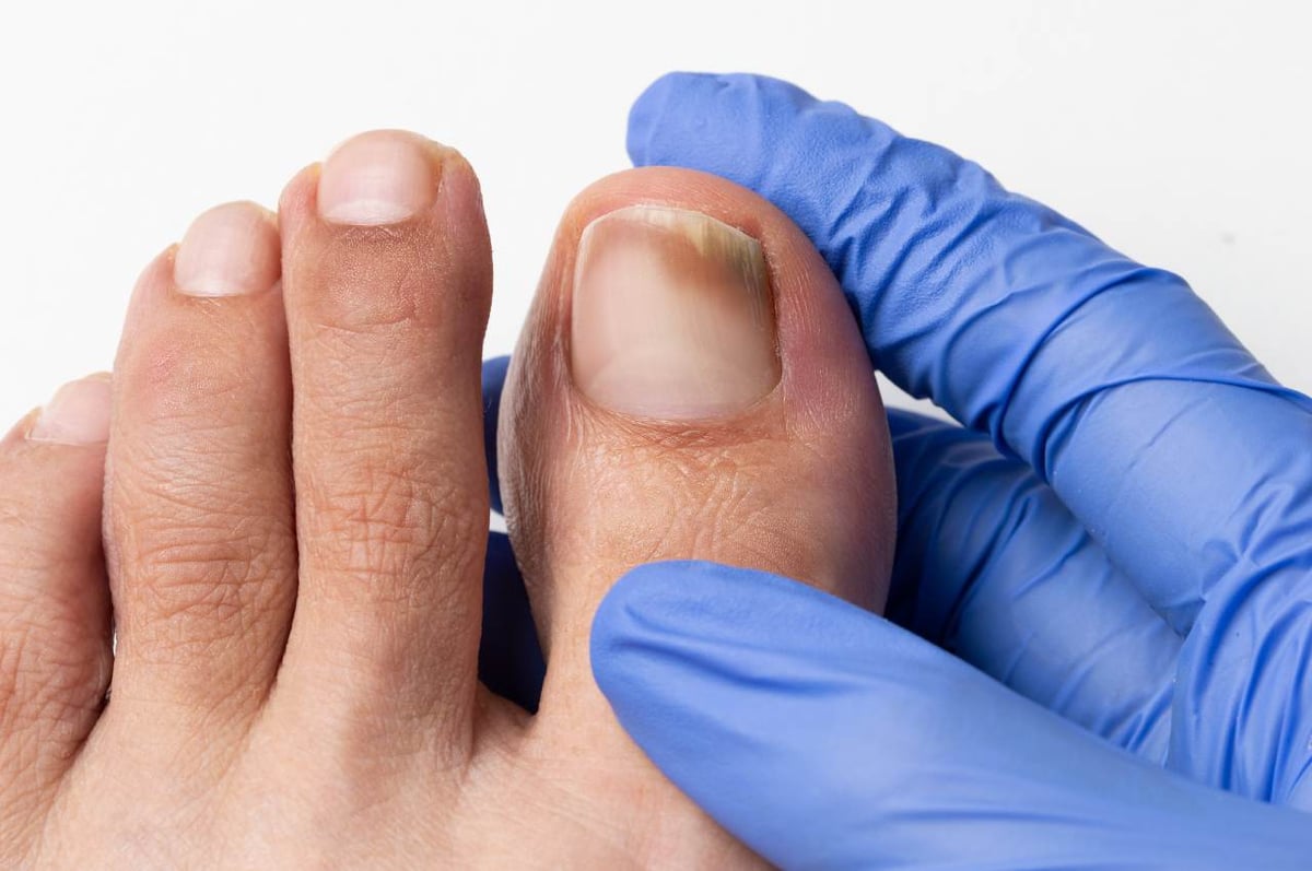 Nagelpilz (Onychomykoase): Fuß mit Zehen wird von Hand mit Handschuh gehalten. Dunkle Verfärbung am Nagel des großen Zehs.