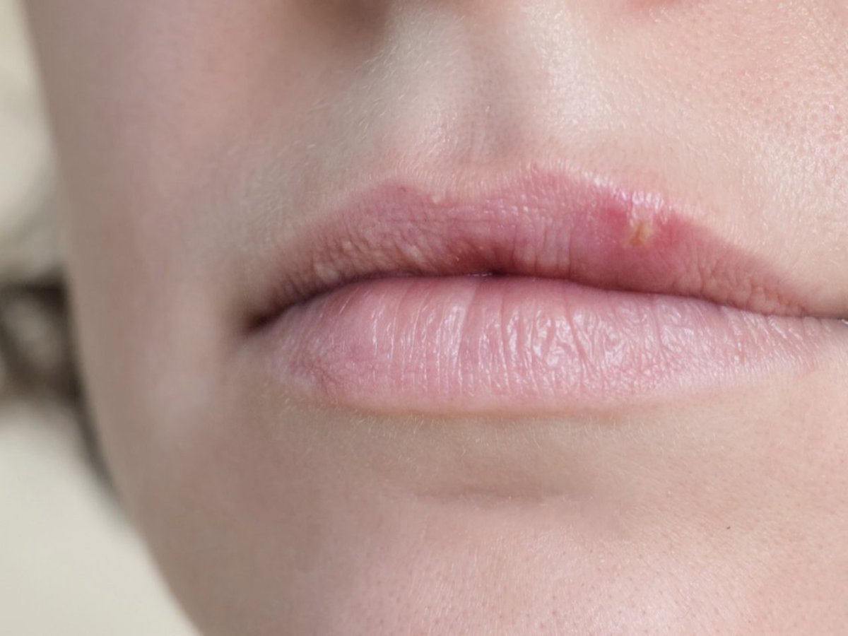 Frau mit Herpes an der Lippe.