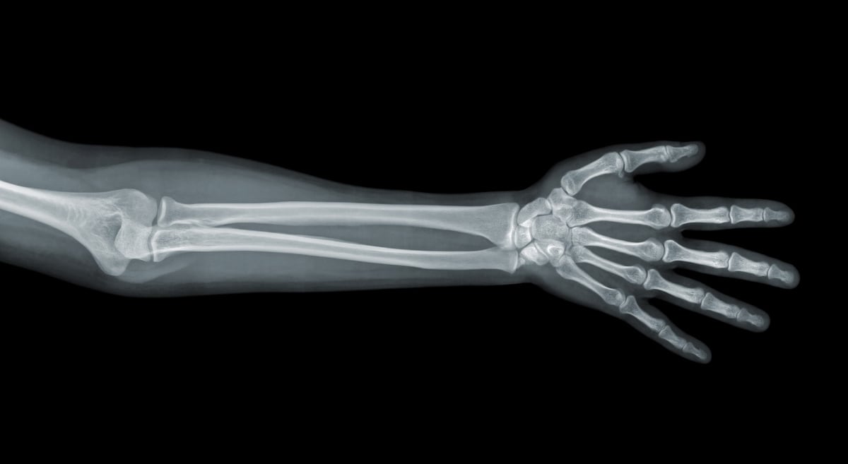 Röntgenbild von Hand und Arm.