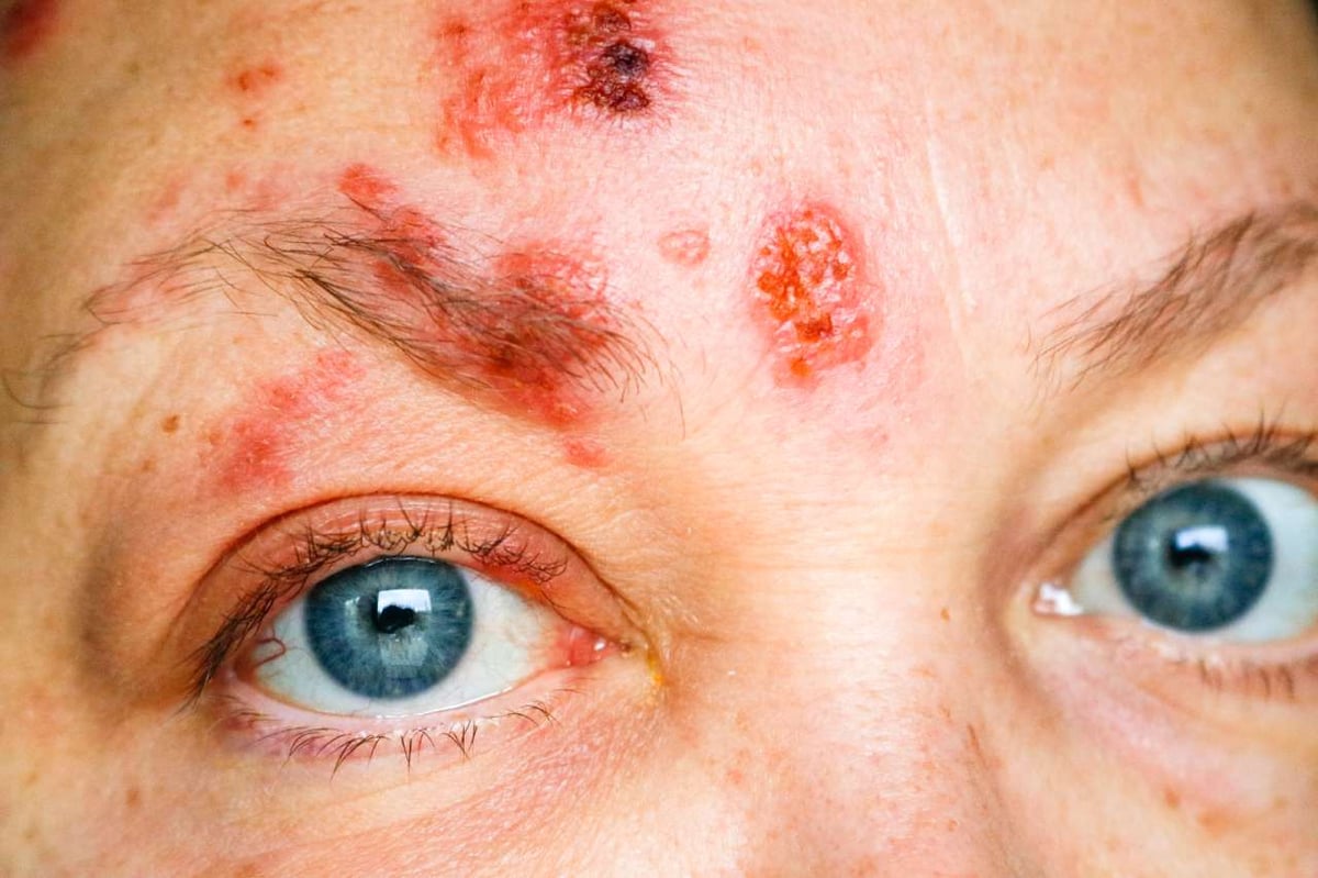 Gesichtsrose ist eine Gürtelrose (Herpes zoster) im Gesicht.