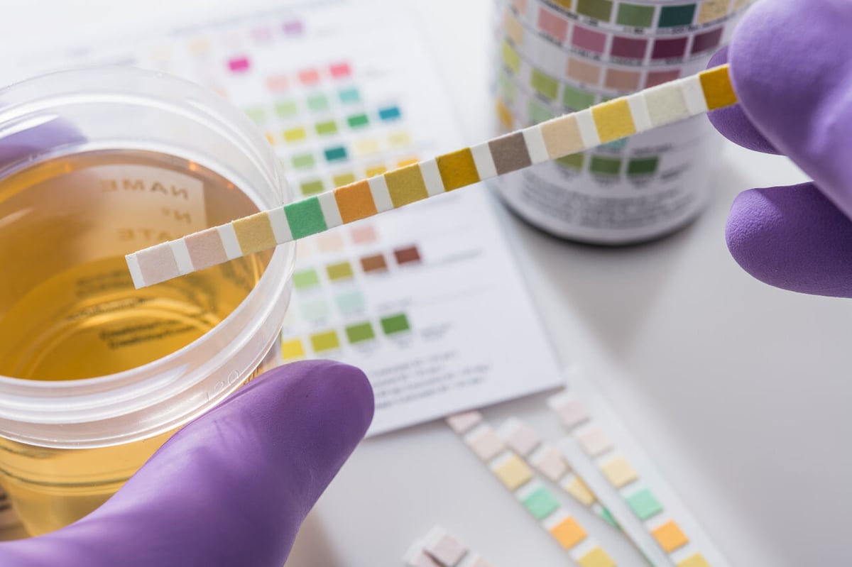 Eine Urinprobe wird im Labor mittels Teststreifen analysiert.