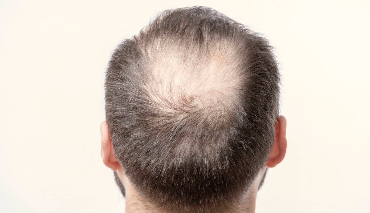 Mann mit lichtem Haar am Hinterkopf.