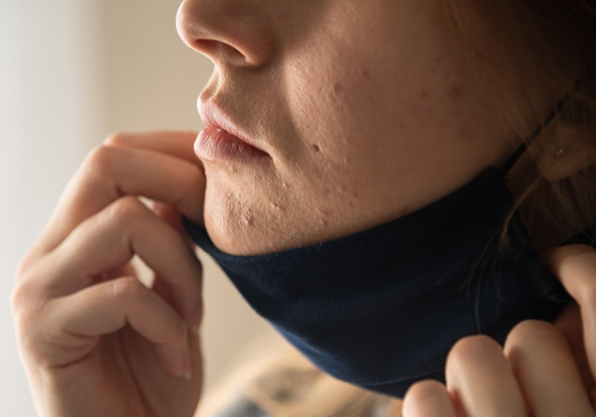 Frau zieht FFP2-Maske herunter und enthüllt Akne.