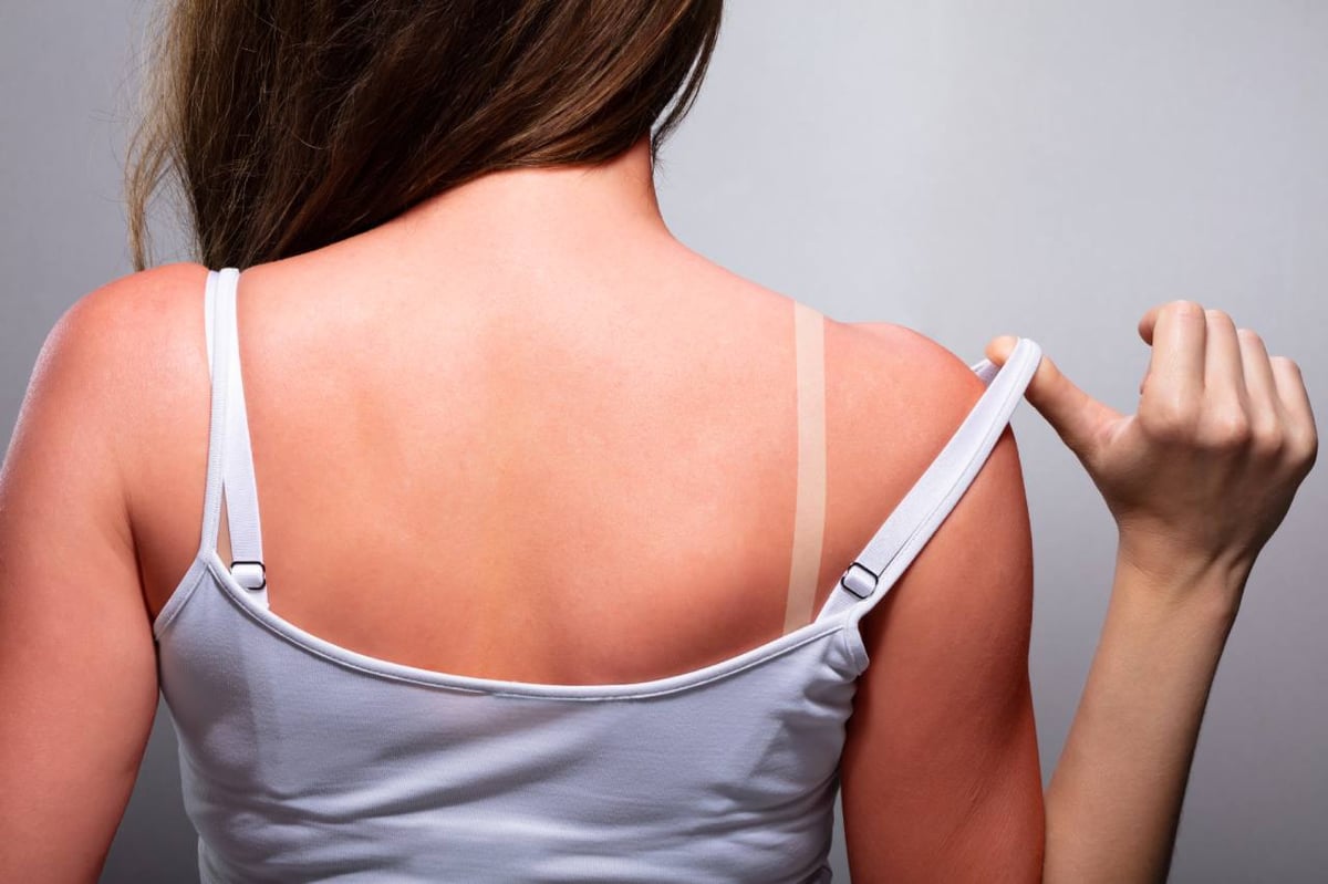 Frau hat Sonnenbrand am Rücken.