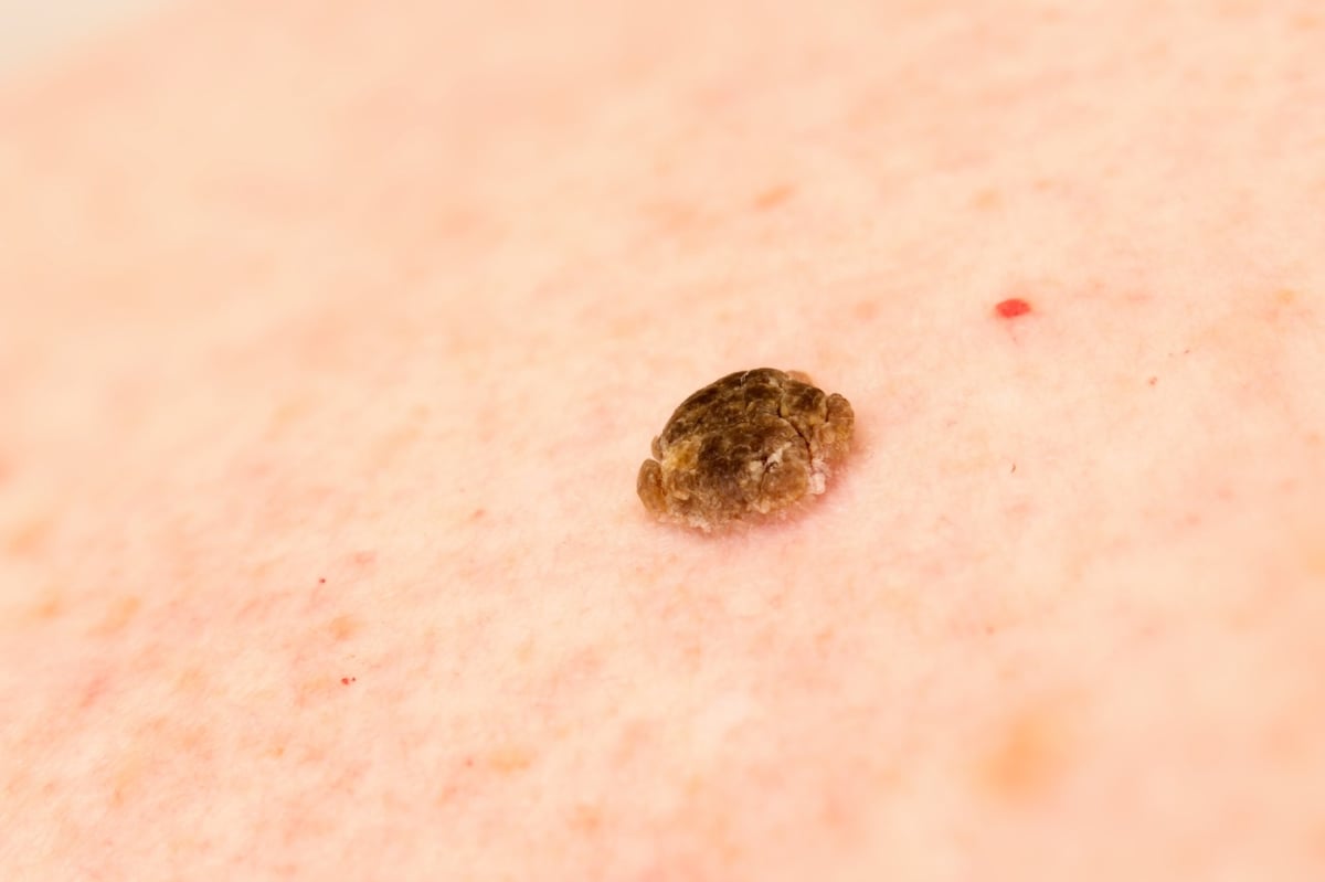 Haut mit Alterswarze (Seborrhoische Keratose) 