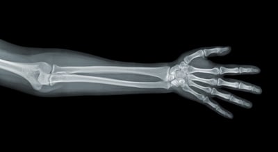 Röntgenbild von Hand und Arm.