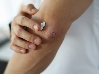 Creme für trockene Haut. Man cremt sich juckende Haut am Ellenbogen ein.