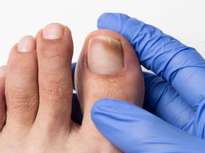 Nagelpilz (Onychomykoase): Fuß mit Zehen wird von Hand mit Handschuh gehalten. Dunkle Verfärbung am Nagel des großen Zehs.