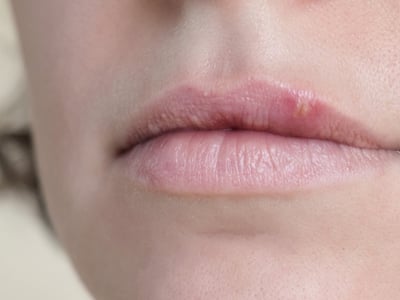 Frau mit Herpes an der Lippe.