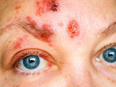Gesichtsrose ist eine Gürtelrose (Herpes zoster) im Gesicht.