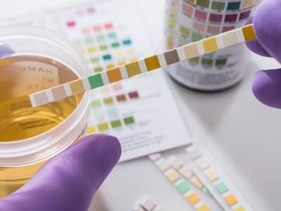 Eine Urinprobe wird im Labor mittels Teststreifen analysiert.