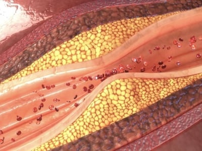 Grafische Darstellung von Blutgefäßen mit Fettablagerungen. Gefäßverengung und Arteriosklerose durch erhöhte Cholesterinwerte.