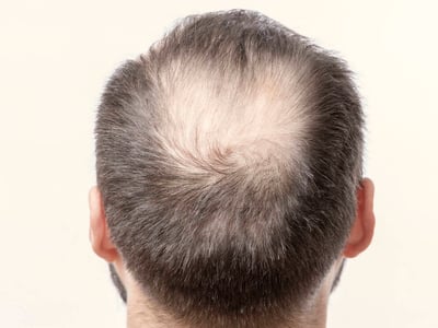 Mann mit lichtem Haar am Hinterkopf.