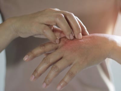 Ekzeme werden häufig von Allergien ausgelöst und gehen mit Juckreiz einher.
