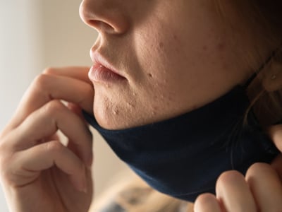 Frau zieht FFP2-Maske herunter und enthüllt Akne.