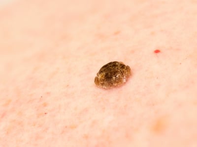 Haut mit Alterswarze (Seborrhoische Keratose) 