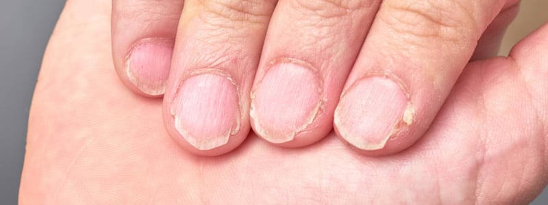 Hand mit brüchigen Fingernägeln.