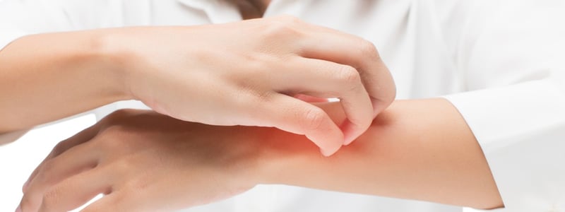 Frau kratzt ihren Arm nach Insektenstich.