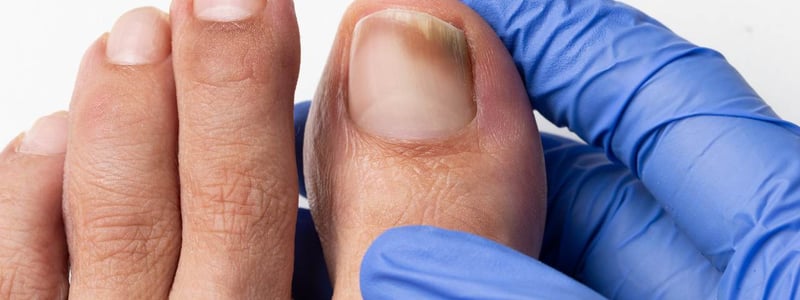 Nagelpilz (Onychomykoase): Fuß mit Zehen wird von Hand mit Handschuh gehalten. Dunkle Verfärbung am Nagel des großen Zehs.