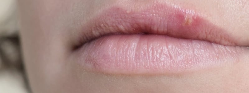 Frau mit Herpes an der Lippe.