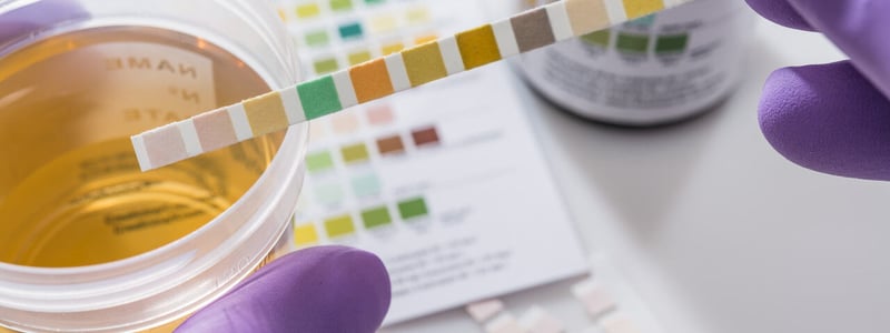 Eine Urinprobe wird im Labor mittels Teststreifen analysiert.