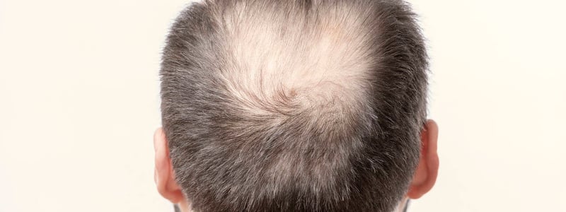 Mann mit lichtem Haar am Hinterkopf.