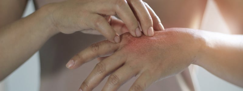 Ekzeme werden häufig von Allergien ausgelöst und gehen mit Juckreiz einher.
