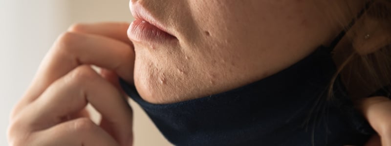 Frau zieht FFP2-Maske herunter und enthüllt Akne.